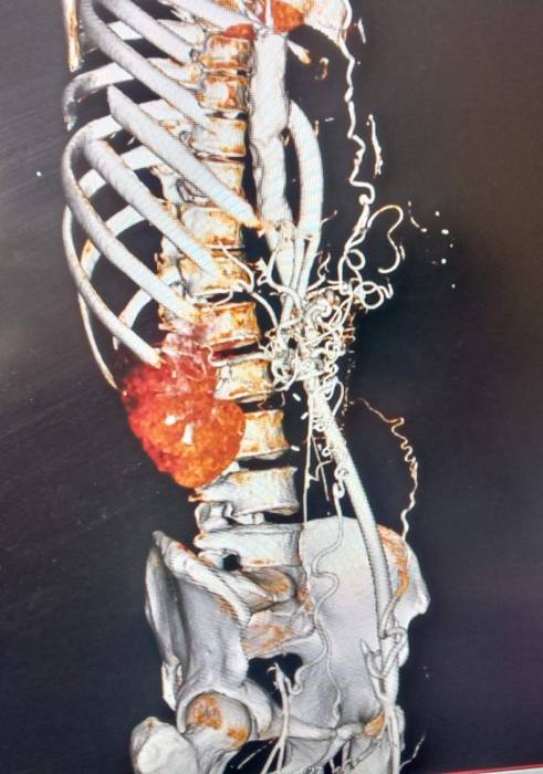 عملية جراحية نوعية لمريض يعاني من أم دم أبهرية (صدرية بطنية) في مدينة الحسين الطبية...