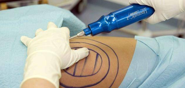 تفاصيل جديدة بوفاة طبيبة جراء عملية شفط