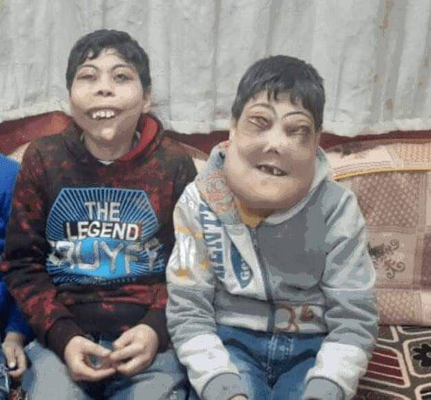 الطبيب المعايطة يتطوع لعلاج طفلين مصريين