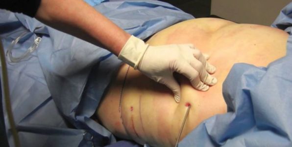 هل عملية قص المعدة خطيرة؟ تعرفوا على السلبيات و المضاعفات