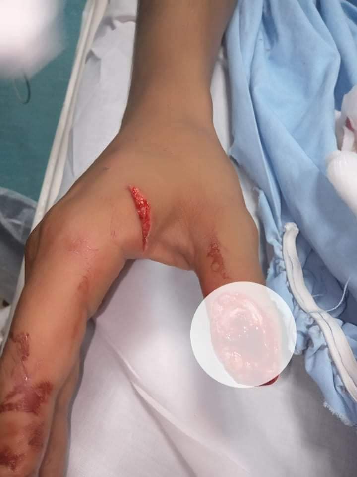 اصابة شخص ببتر ابهام يده في محافظة اربد