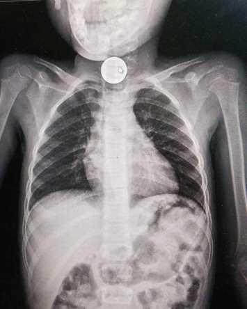 إزالة أجسام غريبة من جهاز هضمي لطفل بالأردن