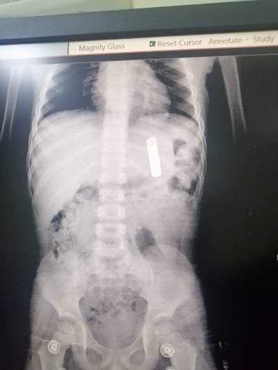 إزالة أجسام غريبة ابتلعها عدة أطفال بالأردن _ صور