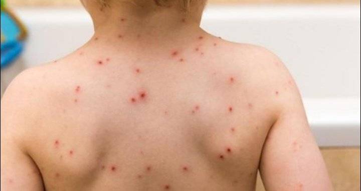 شركس: الاردن قضى على مرض الجدري