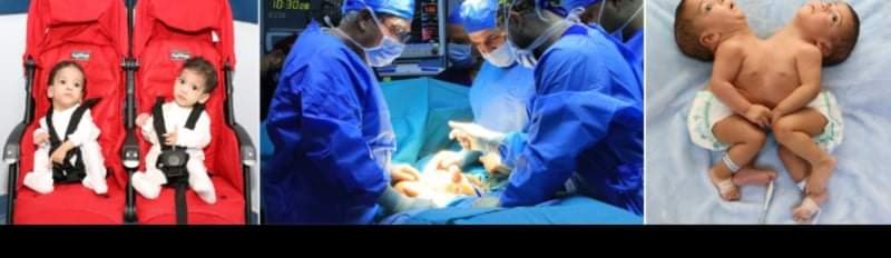 المستشفى التخصصي يسجل أول عملية ناجحة لفصل توأم سيامي ملتصق في الأردن