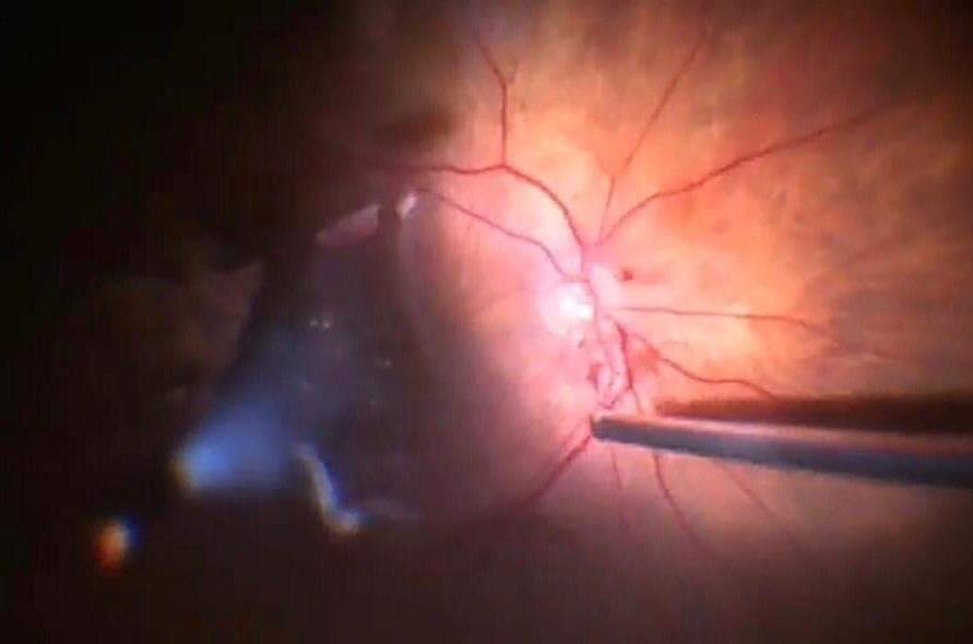 استحداث وحدة شبكية العيون في مستشفى الأميرة هيا بنت الحسين العسكري