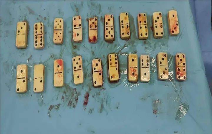 جزائري يبتلع 20 قطعة “دومينو”.. ما القصة؟