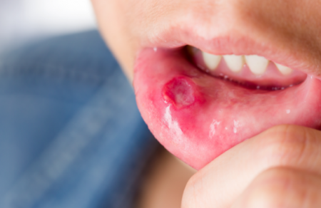 تقرحات الفم .. الأعراض والعلاج وطرق الوقاية