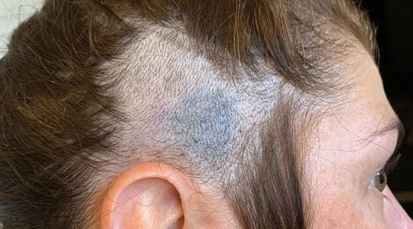 قصة شعر تنقذ حياتها من ورم في رأسها