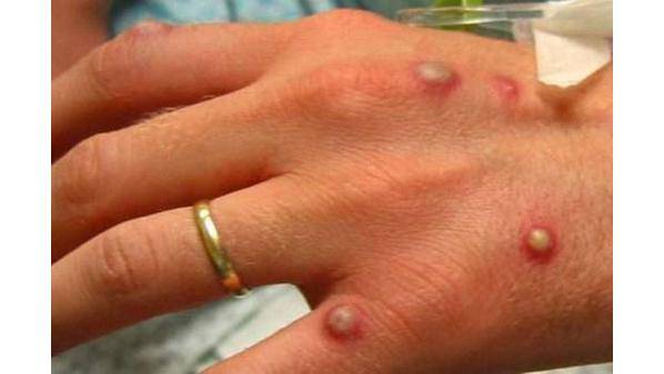 الصحة العالمية: 131 إصابة مؤكدة بجدري القرود في 19 دولة