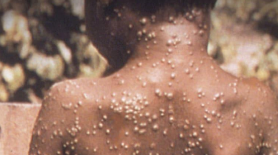 المعاني عن جدري القرود: لن تحصل جائحة