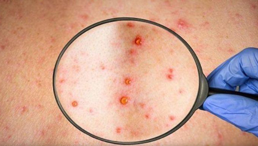 خبراء يحذرون: جدري القرود يستوطن أوروبا في هذه الحالة