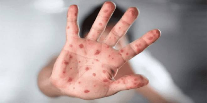 سلوفينيا تعلن عن أول إصابة بفيروس جدري القرود