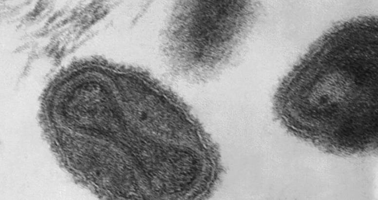 استشاري أوبئة: احتمالية تحوّل “جدري القرود” لجائحة ضئيل جداً