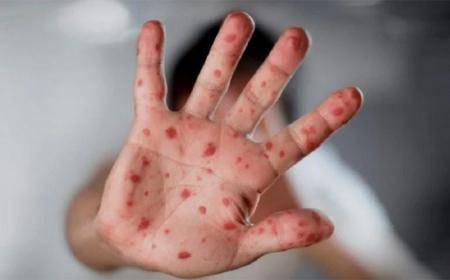 كندا .. ارتفاع عدد الإصابات بجدري القردة إلى 15 حالة