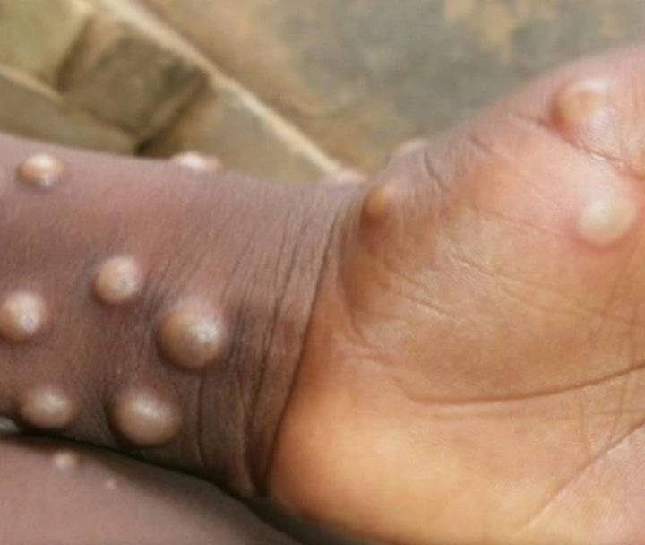 المغرب يعلن خلوه من جدري القردة