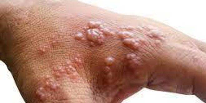 25 إصابة جديدة بفيروس جدري القرود في إسبانيا