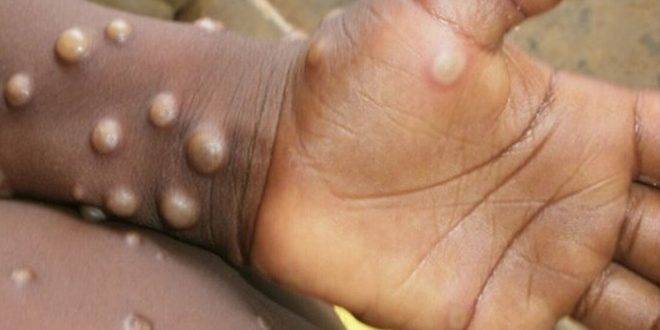 كندا تسجل 10 إصابات جديدة بجدري القرود