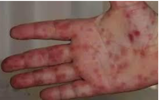 هل أنفلونزا الطماطم مميتة؟ .. استشاري يجيب