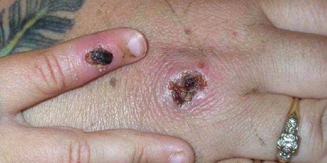 تونس تكثف الرقابة على المعابر الحدودية توقيان من جدري القردة