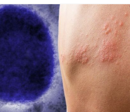 الصحة العالمية: جدري القرود انتشر لفترة دون اكتشافه