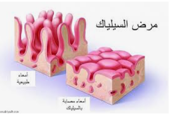 السيلياك مرض مناعي وراثي يحرم المصابين من مواد غذائية أساسية