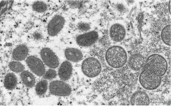 جدري القرود.. الإعلان عن حصيلة عالمية جديدة