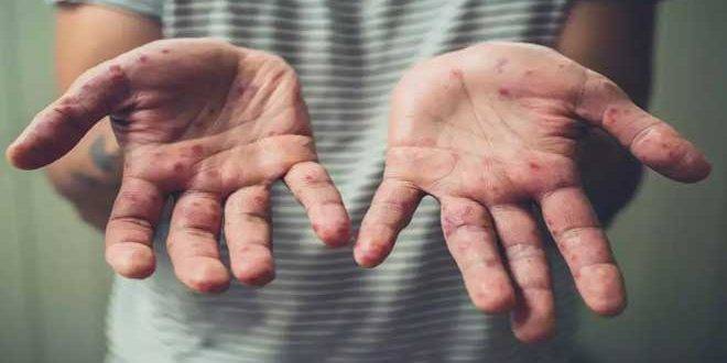 فرنسا تسجل 51 إصابة بجدري القردة