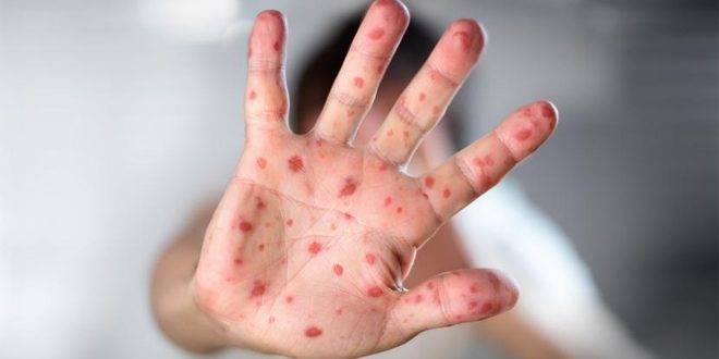 رومانيا تعلن تسجيل أول إصابة بفيروس جدري القردة