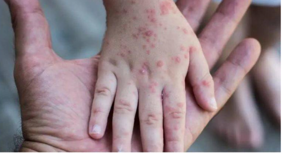 إسرائيل تسجل إصابة خامسة بجدري القردة