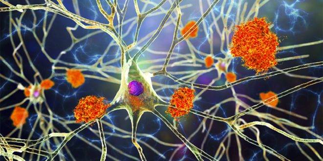 دراسة أسترالية: نقص فيتامين (د) يؤدي إلى تدهور الدماغ والإصابة بالخرف