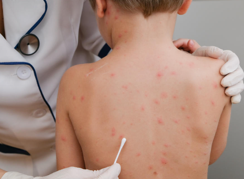 هل يخطو جدري القرود خطا كورونا؟.. خبراء يجيبون