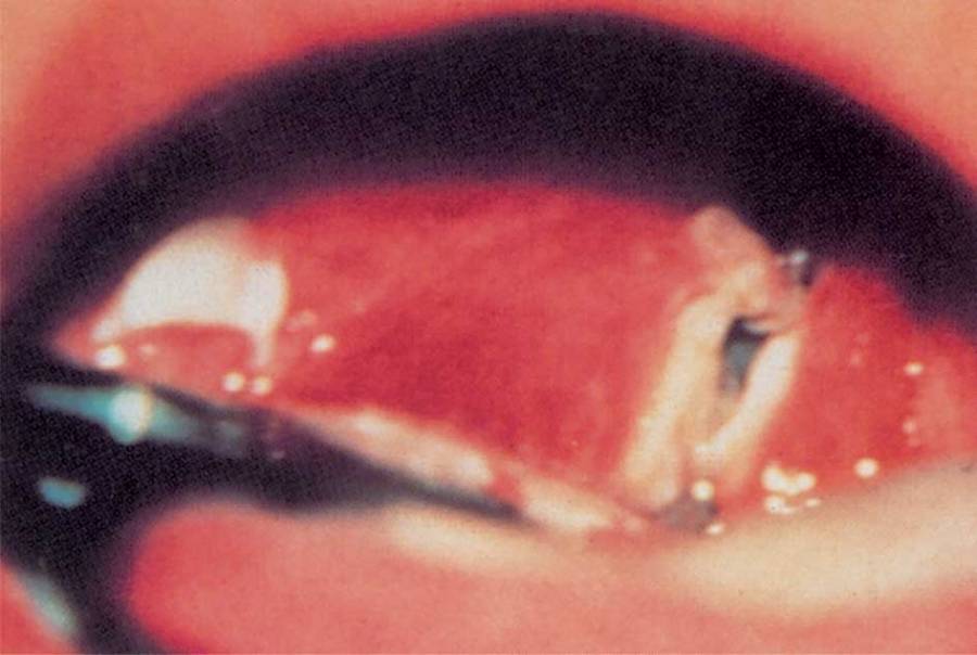 سوريا : رصد حالة دفتريا (الخناق) فما هو هذا المرض