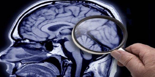 تطوير تقنية جديدة لتشخيص الزهايمر بسرعة ودقة عالية