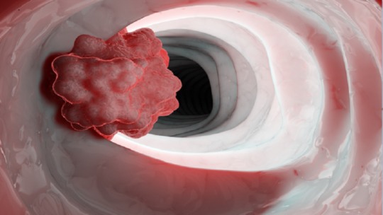 خضروات تزيد من خطر الإصابة بسرطان المريء