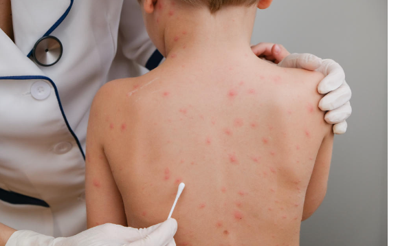 الصحة العالمية تطلق توصيات جديدة لمواجهة جدري القرود