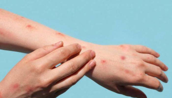 يهدد الفئات الأضعف.. تحذير أممي من خطورة جدري القرود