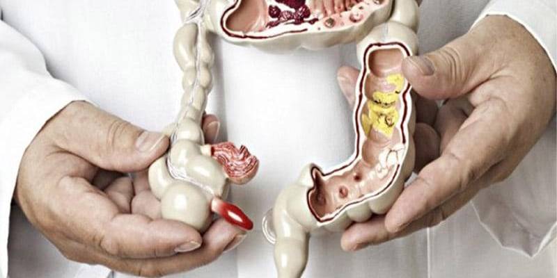 3 اعرض رئيسة لاكتشاف سرطان القولون.. تعرَّف عليها
