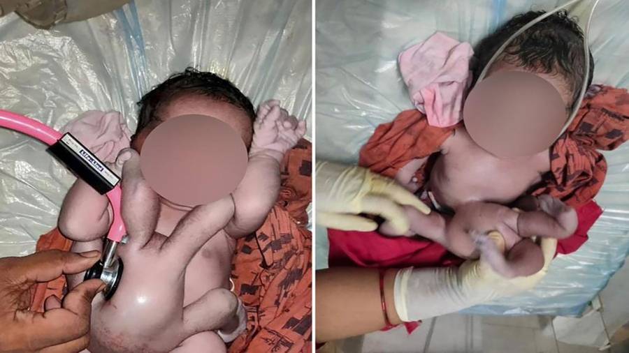 ولادة طفلة بـ 4 أذرع و4 أرجل في الهند...سبحان الله