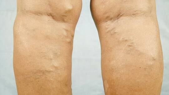 طبيبة روسية توضح كيف يمكن منع ظهور الدوالي