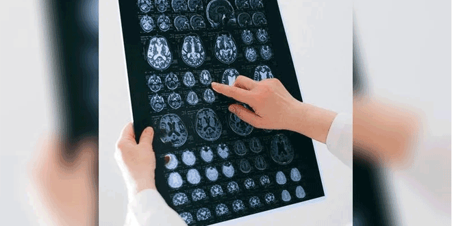 مؤسسة أبحاث السرطان في بريطانيا..11700 مريض بأورام الدماغ