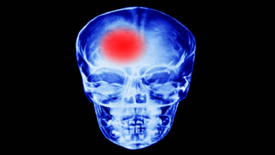 عمره منع المسعفين من تصديق حالته.. رجل يصاب بسكتة دماغية محيّرة!