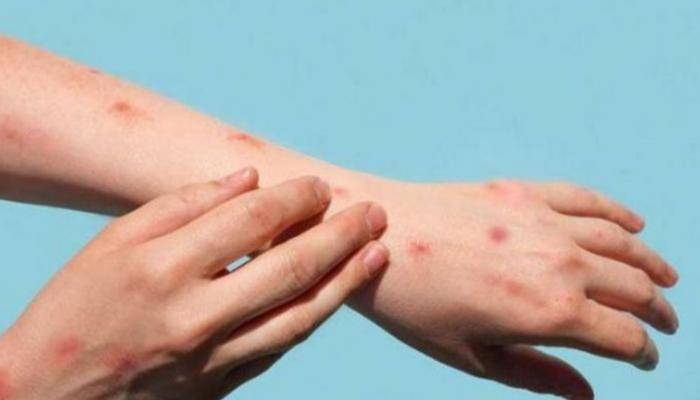 2000 إصابة بجدري القرود في ألمانيا