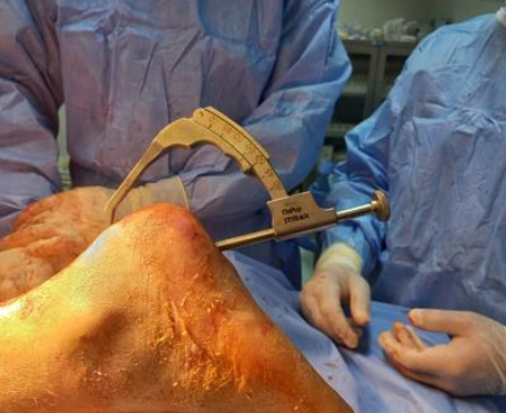 عملية نوعية في مستشفى البشير لشاب تعرض لإصابة أثناء ممارسة الرياضة