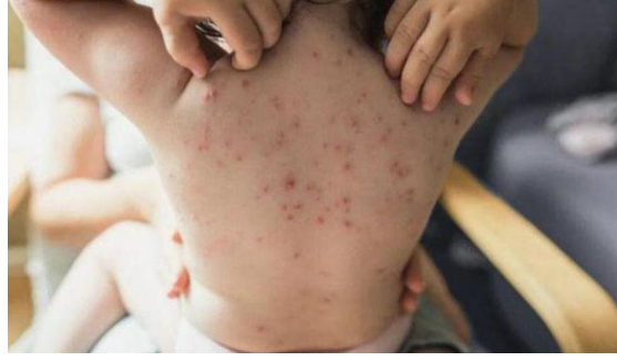 طرق هامة للوقاية من جدري القرود