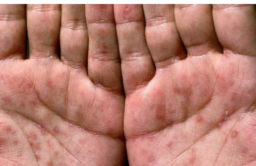 إعلان شفاء رابع مريض بالعالم من الايدز