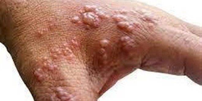 استراليا تحذر من خطورة جدري القردة على البلاد