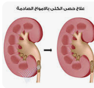 ما هي أحدث الطرق في علاج حصى الكلى؟