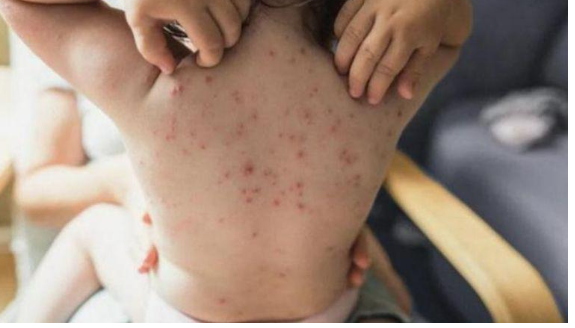 البلبيسي: لا يوجد مطعوم ضد جدري القرود بالأردن