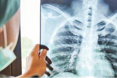 وزارة الصحة: مرض السل قابل للشفاء التام